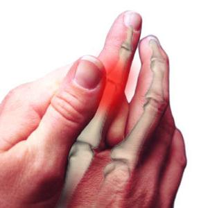 Artritída prstov: liečba, príčiny, príznaky