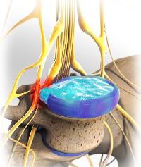 liečba intervertebrálnej hernie 