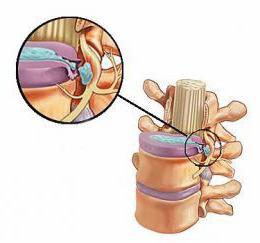 paramedická disk herniácia l5 s1 