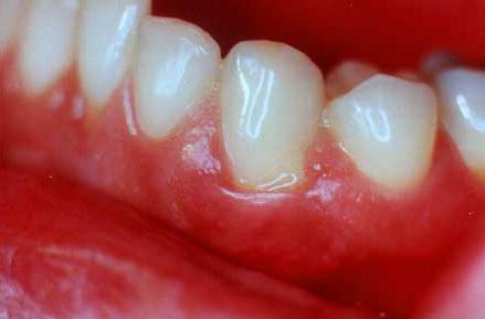 Krvácanie z guma: čo liečiť a aké sú príčiny tejto choroby?