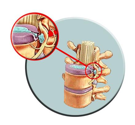 liečba vertebrálnej hernie