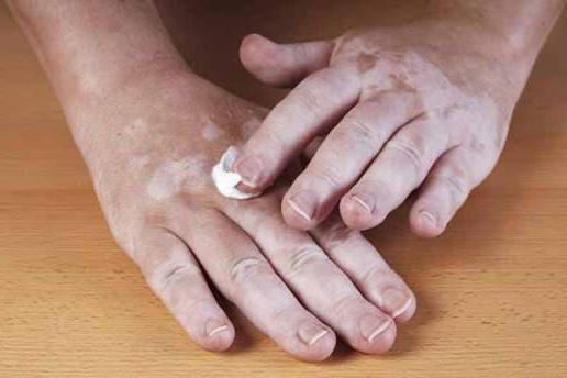 vitexový gél z vitiligo